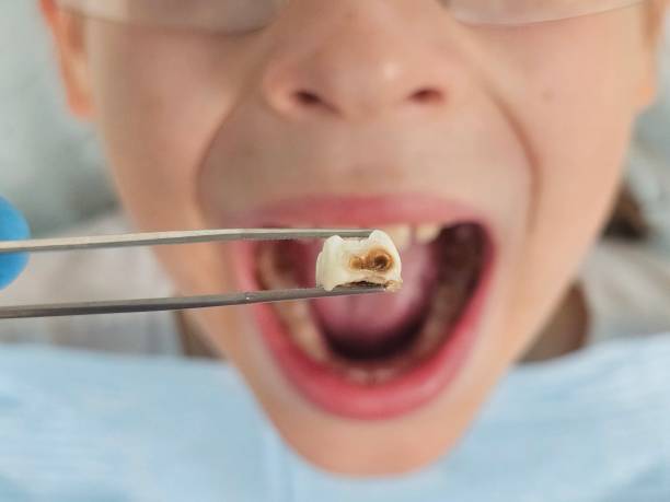 Best Broken or Chipped Tooth Repair in Hamilton, MT